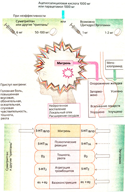 А. Лечение приступов мигрени