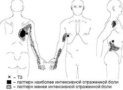 Рис. 4. Локализация Т3 и паттерн отраженной боли при МФБС широчайшей мышцы спины