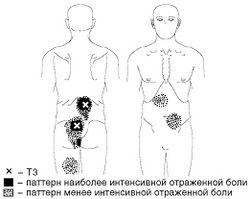 Рис. 9. Локализация ТЗ и паттерн отраженной боли при МФБС в многораздельных мышцах