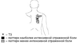 Рис. 6. Локализация Т3 и паттерн отраженной боли при МФБС ромбовидной мышцы