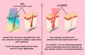 IPL vs Laser.jpg