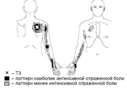 Рис. 5. Локализация Т3 и паттерн отраженной боли при МФБС верхней задней зубчатой мышцы