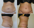 Abdominoplastika.jpg